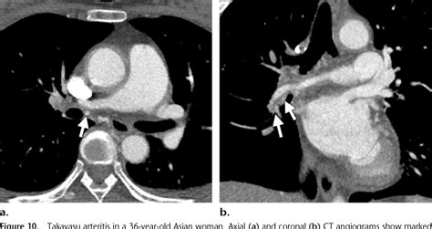 Figure 7 from Bronchial arteries: anatomy, function, hypertrophy, and ...