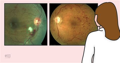 A Resident's Guide to Diabetic Retinopathy Surgical Treatment Options