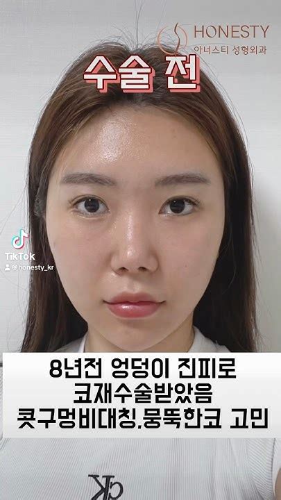 아너스티성형외과코재수술코재수술후기코재수술전후rhinoplastybeforeandaftercontractednose