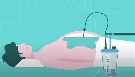 Paracentesis Risks And Complications Of Paracentesis A2z Healthy