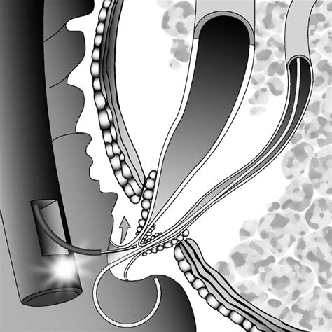 12 Schematic Showing Needle Knife Precut For Biliary Access Using A