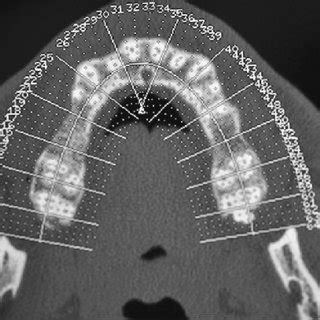 Anatomical Considerations On The Alveolar Antral Artery As Related To