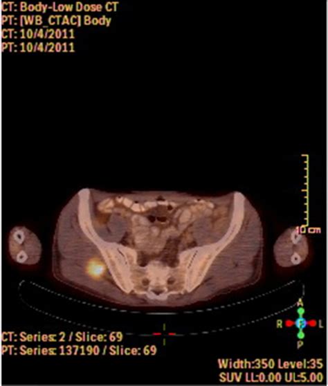 Figure From Gluteus Medius Muscle Metastasis Of Squamous Cell