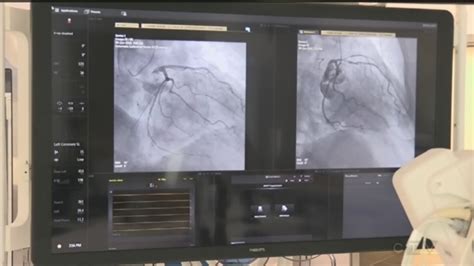 Barrie hospital reaches another milestone in cardiac care | CTV News