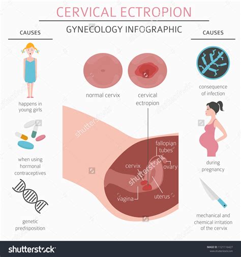 Cervical Ectropion Ginecological Medical Desease Infographic Stock Vector (Royalty Free) 1121116427