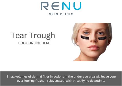 Tear Trough Treatment To Treat Undereye Hollowness And Dark Circles