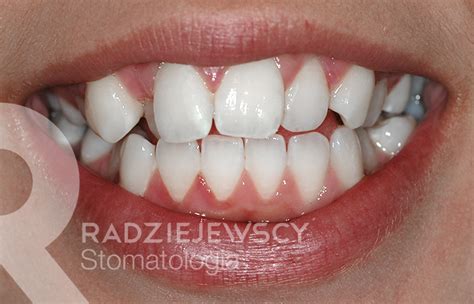 Metamorfozy Stomatologia Radziejewscy Ortodoncja I Nak Adki Invisalign