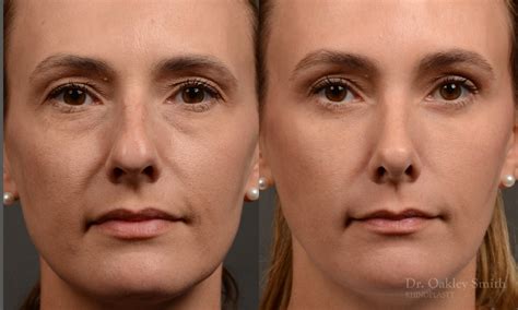 Rhinoplasty Before And After Case 453 Toronto Rhinoplasty Surgery