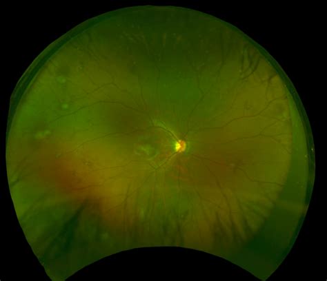 Retinal Nevus Icd 9 Code