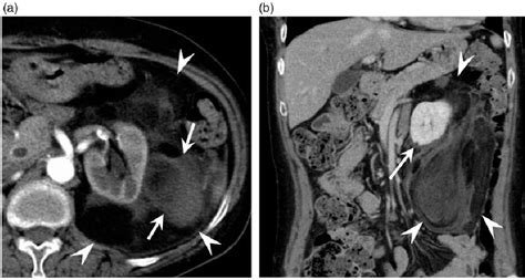 Figure 1 From Exophytic Renal Angiomyolipoma And Perirenal Liposarcoma