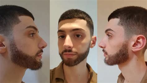 Beard Transplant Turkey Hair Center