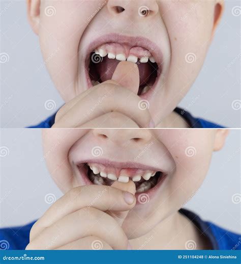 Before And After Loose Baby Teeth From Above The Boy Shows That The