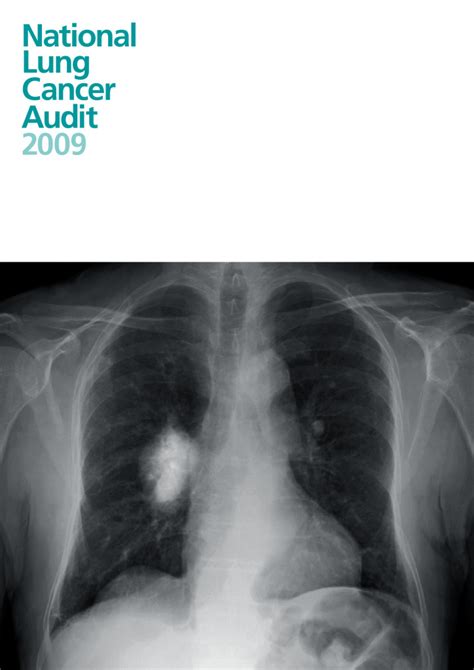 National Lung Cancer Audit 2009 Hqip