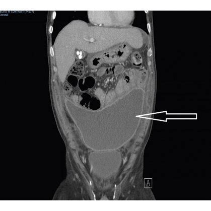 A Computed Tomography CT Abdomen Pelvis Cross Sectional View