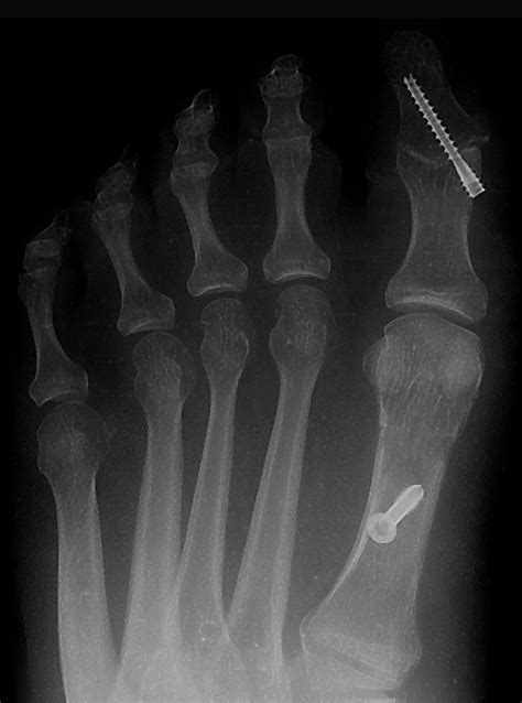 Hallux Interphalangeal Joint Arthrodesis The Journal Of Foot And