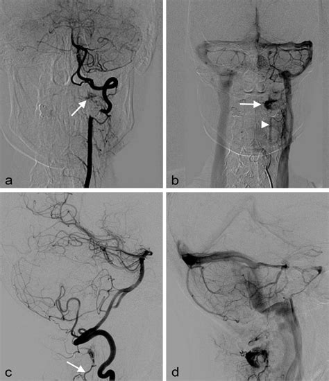 Frontal Projection Of The Left Vertebral Angiogram In The Arterial