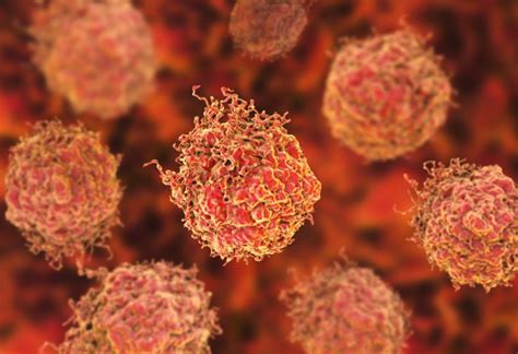 Describen cómo las células de cáncer de próstata imitan al hueso cuando ...