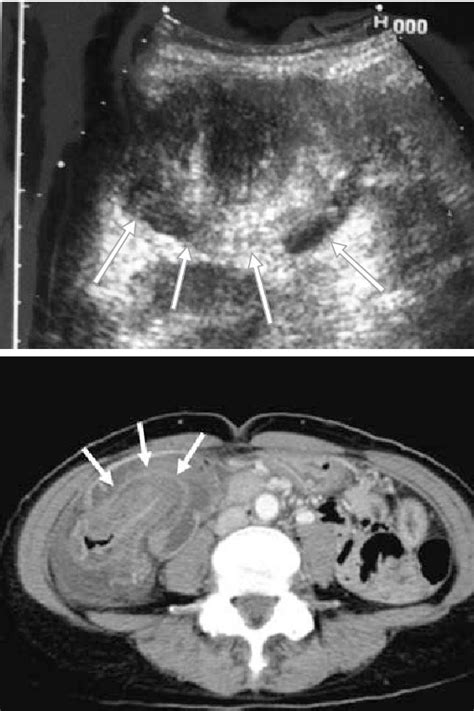 Figure From A Case Of Idiopathic Colonic Intussusception In An Adult