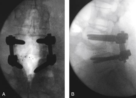 Transforaminal Lumbar Interbody Fusion Musculoskeletal Key