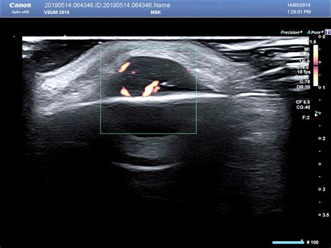 VIETNAMESE MEDIC ULTRASOUND CASE 553 MANTLE CELL LYMPHOMA DR PHAN