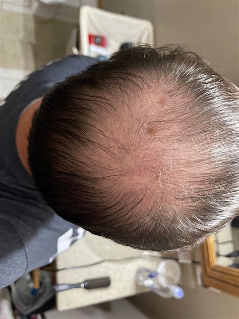 2 Months Finasteride 2x Minoxidil Per Day Microneedling Every 5 Days R Tressless