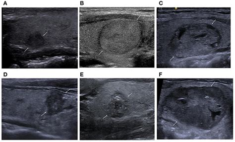 Cancerous Thyroid Nodules Characteristics