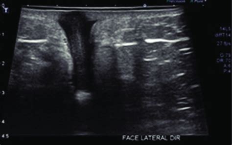 Soft Tissue Ultrasound Image Skin And Subcutaneous Tissue Presenting