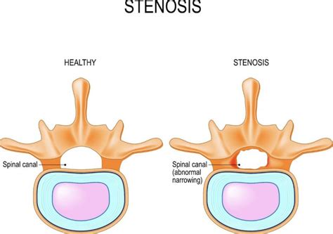 Best Treatment For Severe Foraminal Stenosis Best