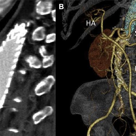 Preoperative Contrast Enhanced Computed Tomography Ct Scan A Aortic