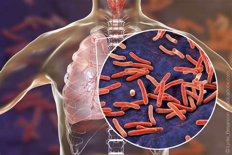 Tuberculosis Tuberculosis New Insights Into The Pathogen Universitat