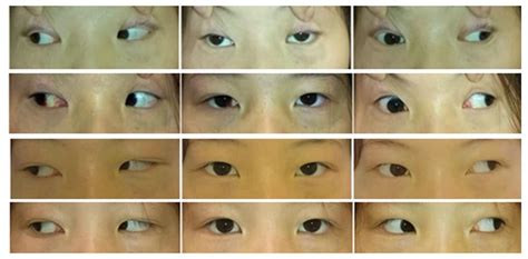 eye position  patient  photographs  eye position  top