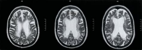 Neuro 2 Karteikarten Quizlet