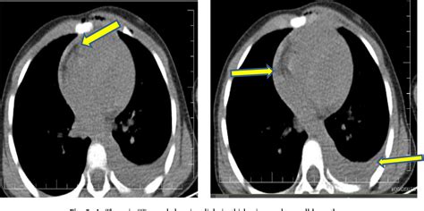 Figure 3 From Management Of An Accidental Penetrating Cardiac Injury In