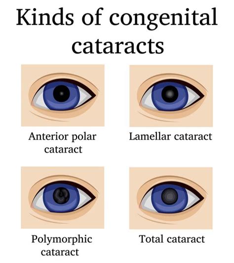 Congenital Cataract Types Causes Symptoms And Treatment Baby