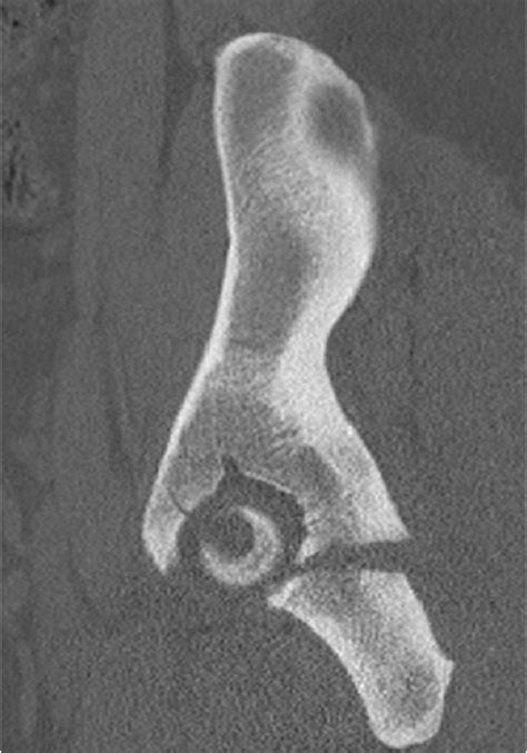 Figure 4 From Catastrophic Failure Of An Acetabular Stress Fracture In