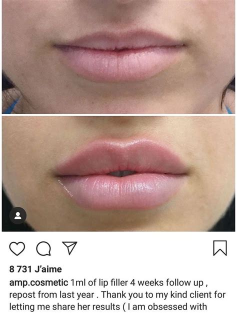 Lip Filler Before After Artofit