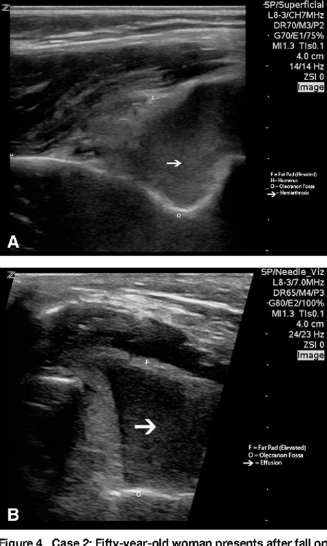 Elbow Ultrasound Anatomy