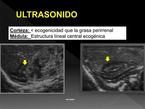 Incidentalomas De La Glandula Suprarenal Ppt