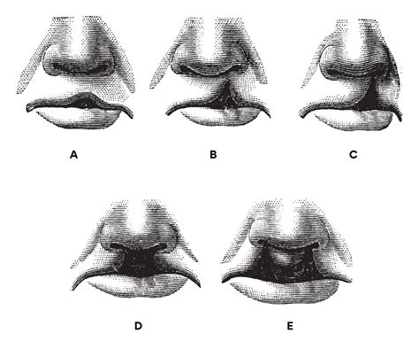 Cleft Palate Types