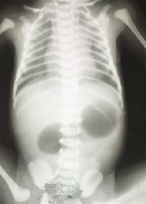 Diagnosis Atresia Intestinal Alomedika