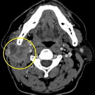 Salivary Duct Carcinoma Of The Parotid Gland Originating From An