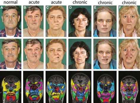 Patient Before And After Onset Of Acute Complete Peripheral Facial