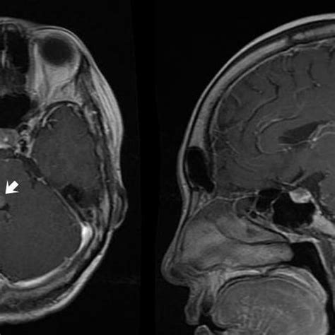 Contrast Enhanced Transverse Left And Sagittal Right T Weighted