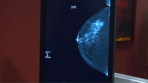 New 3d Mammogram Technology To Help In Early Cancer Detection Khgi