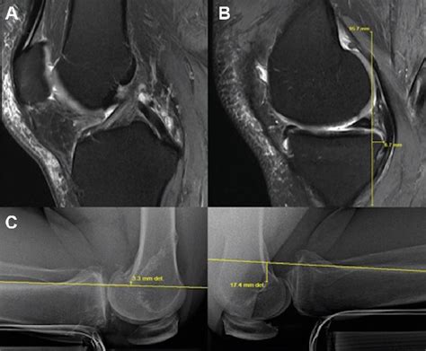 Pdf Posterior Tibial Translation Measurements On Magnetic Resonance