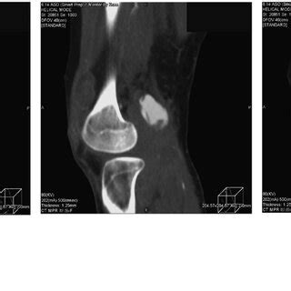 A Preoperative Contrast Enhanced Computed Tomography Sagittal View