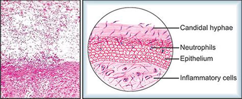 Oral Candidiasis Histology