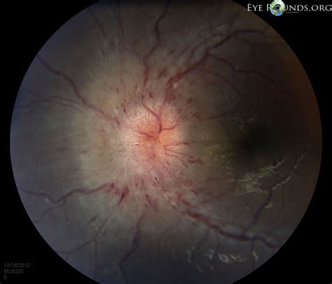 Online Atlas Of Ophthalmology The University Of Iowa Ophthalmology