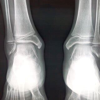 Showing bilateral feet with medial malleolus swelling | Download Scientific Diagram