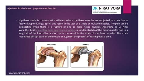 PPT - Symptoms for Hip Flexor Strain Causes By Dr. Niraj Vora ...